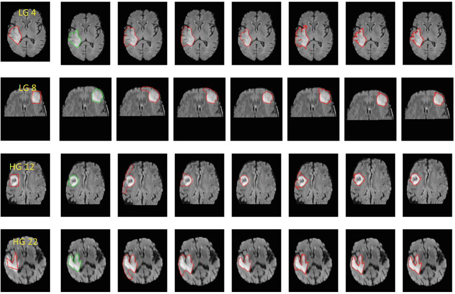 brain tumor